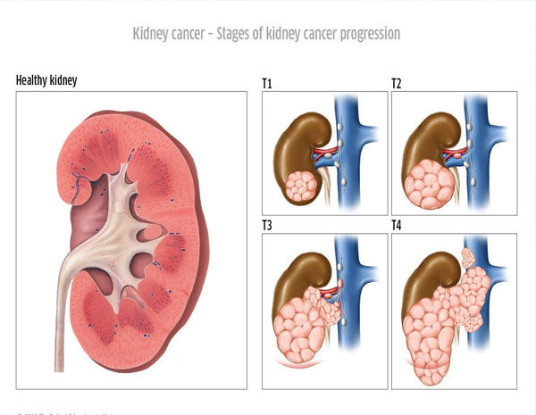 Uro-Oncology
