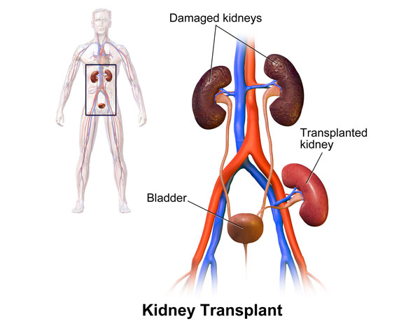 kidney-transplant