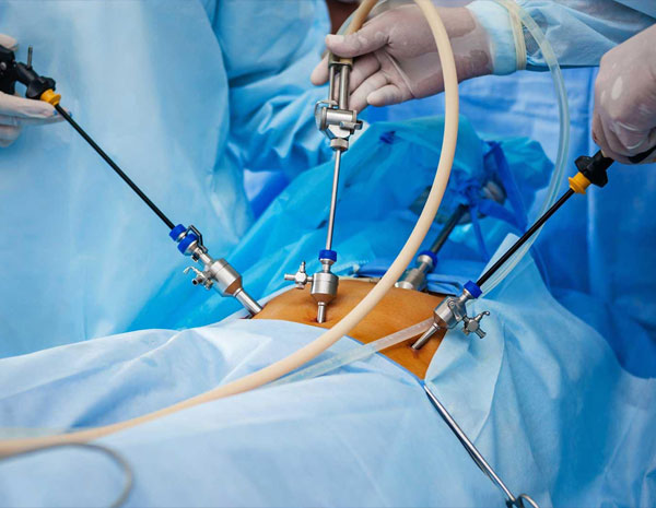 laparoscopic-surgery