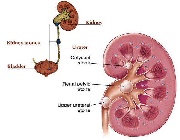 Kidney Stone Treatment laser