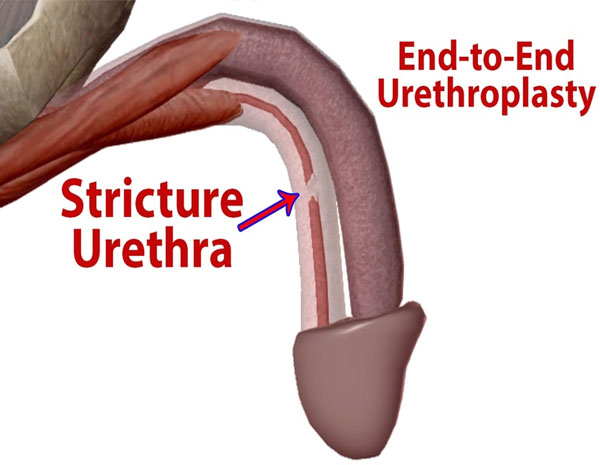 uroplasty